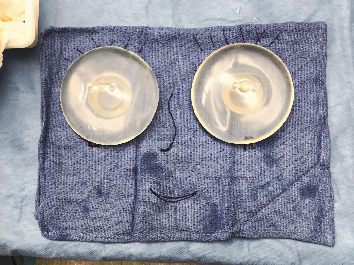 Breast Implant Safety Insights from Dr. Itay Wiser