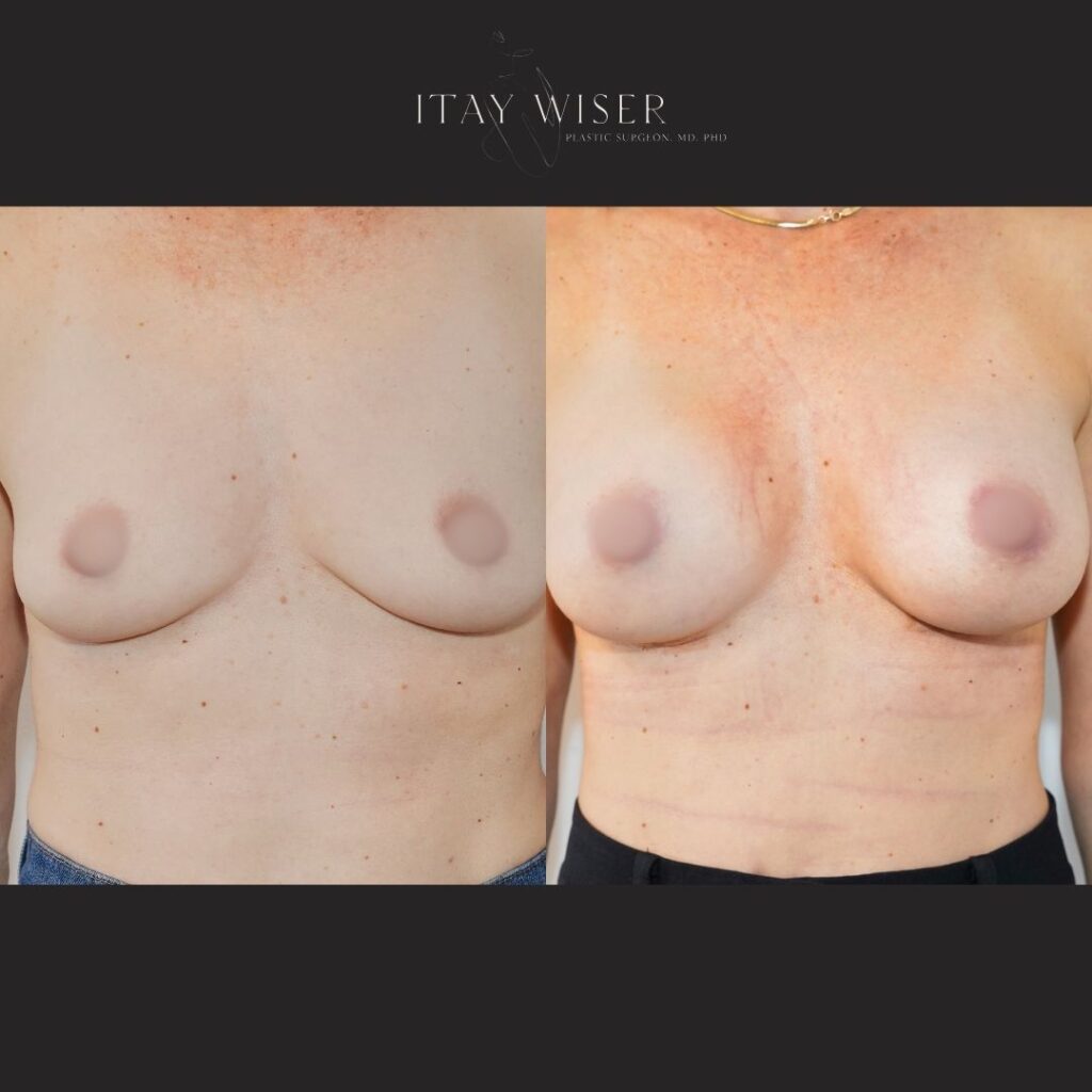 Breast Augmentation