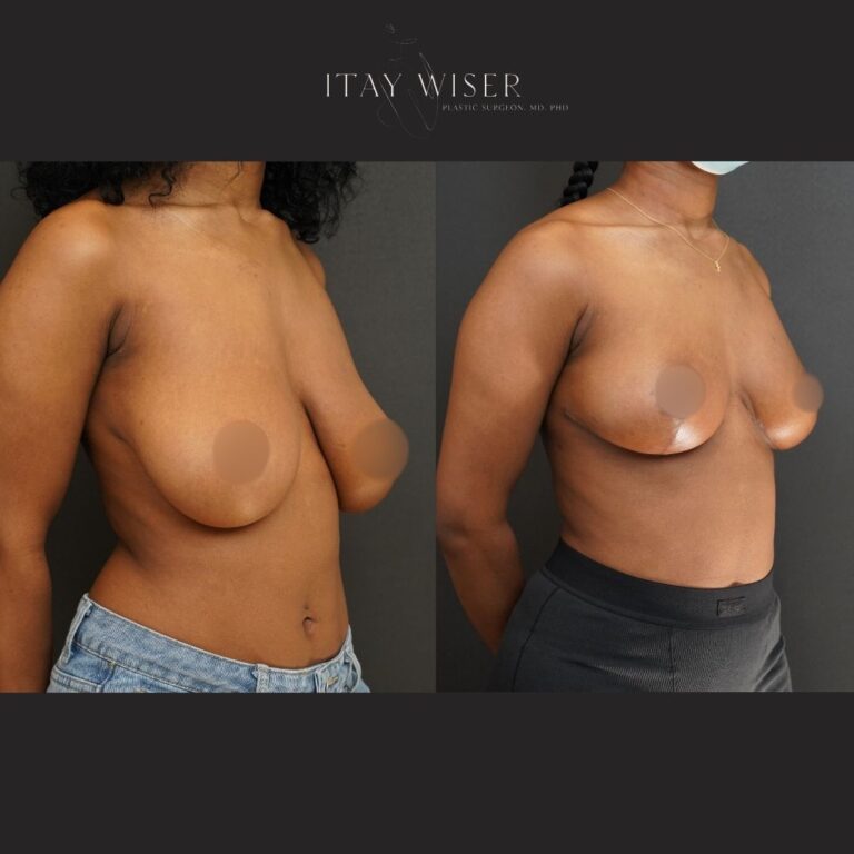 Breast reduction