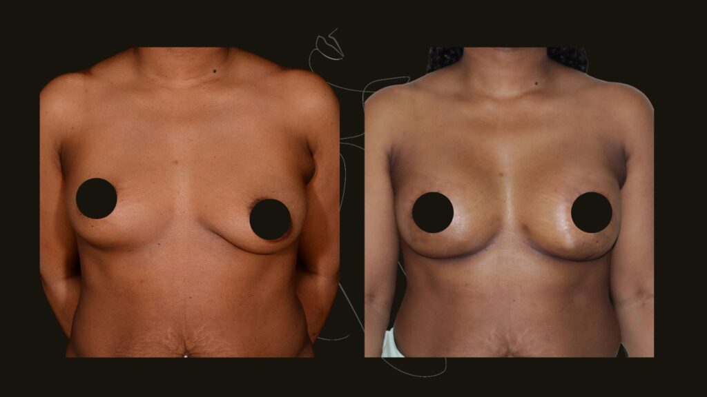 Breast Assymetry