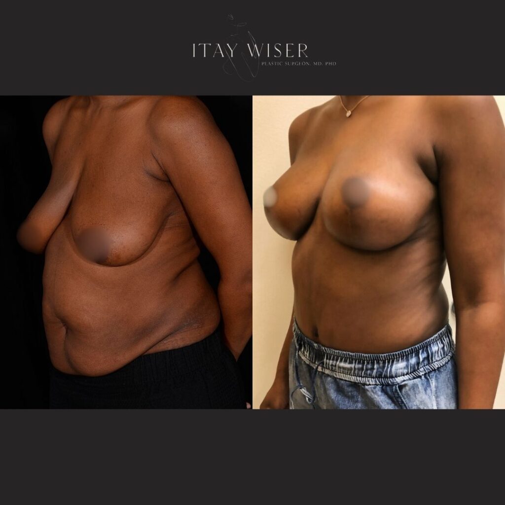 mommymakeover