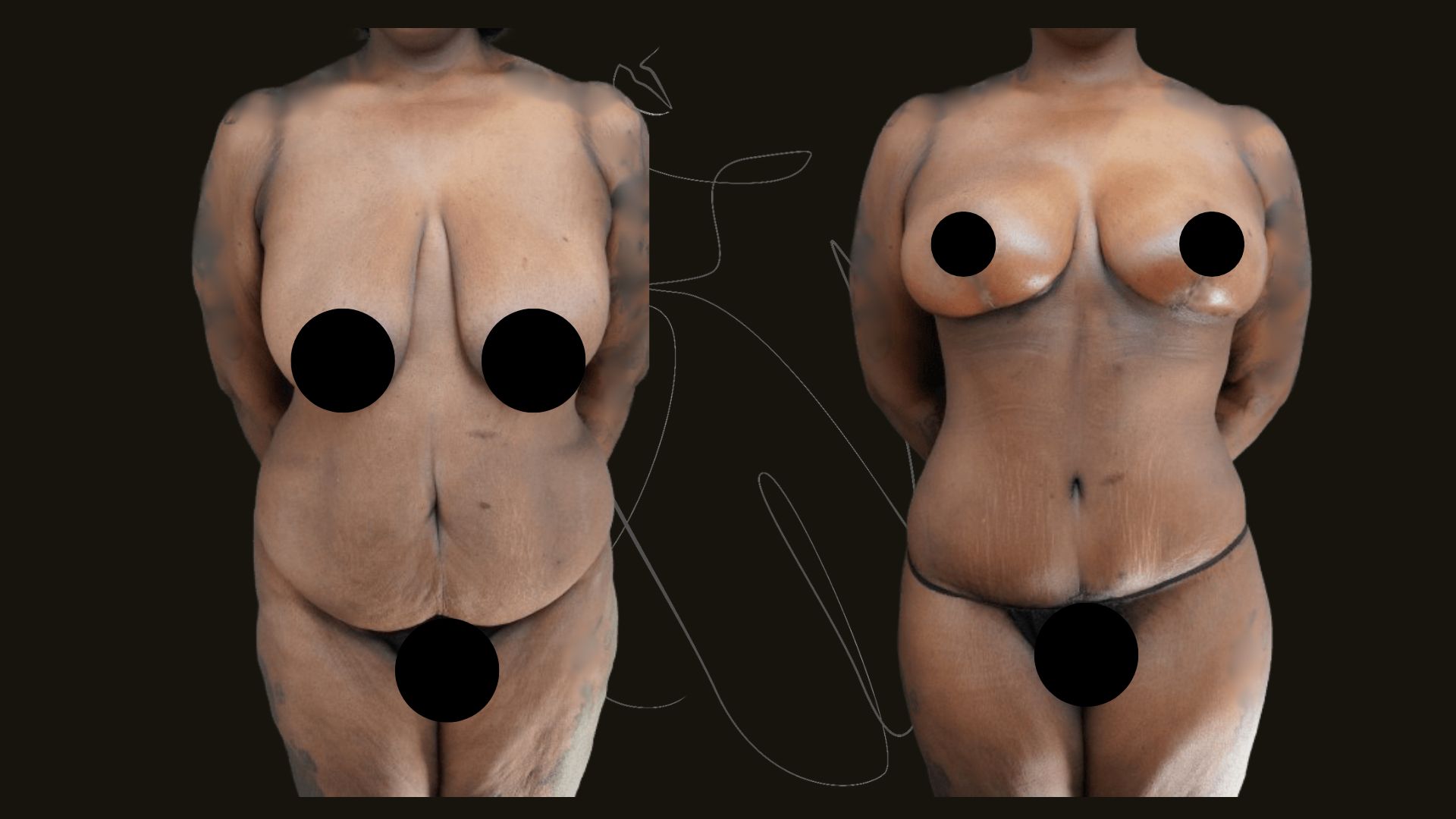 Mommy Makeover