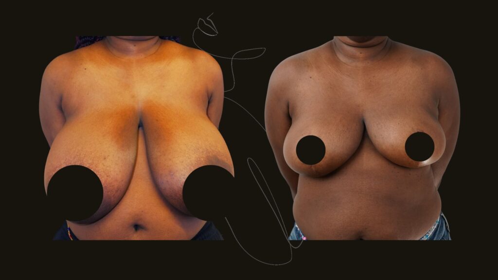 breast reduction