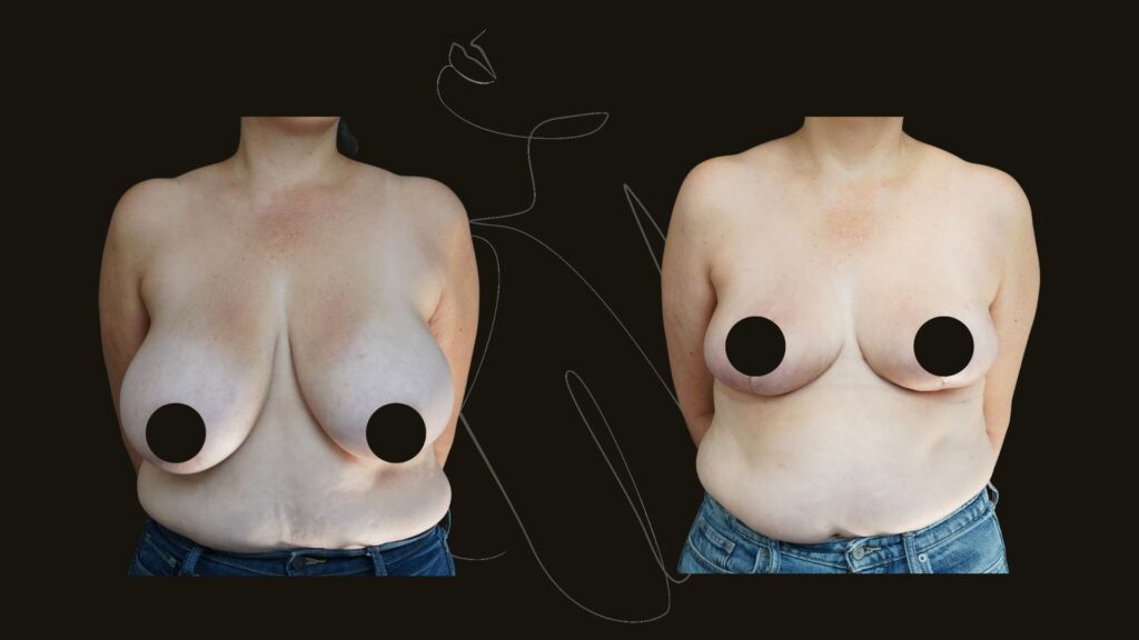 Breast reduction NYC