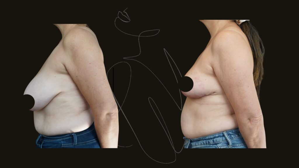 breast reduction