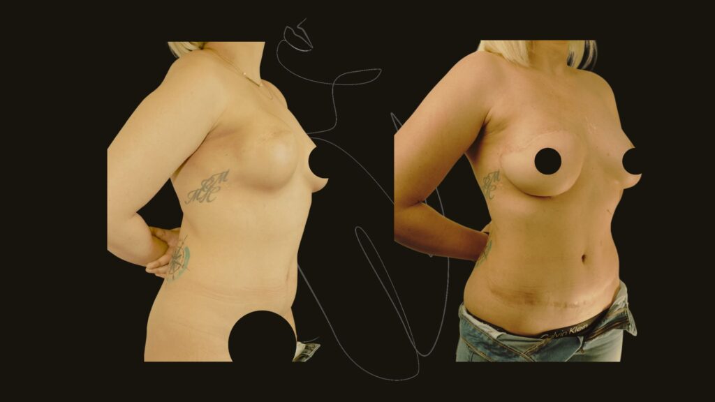 Breast Asymmetry