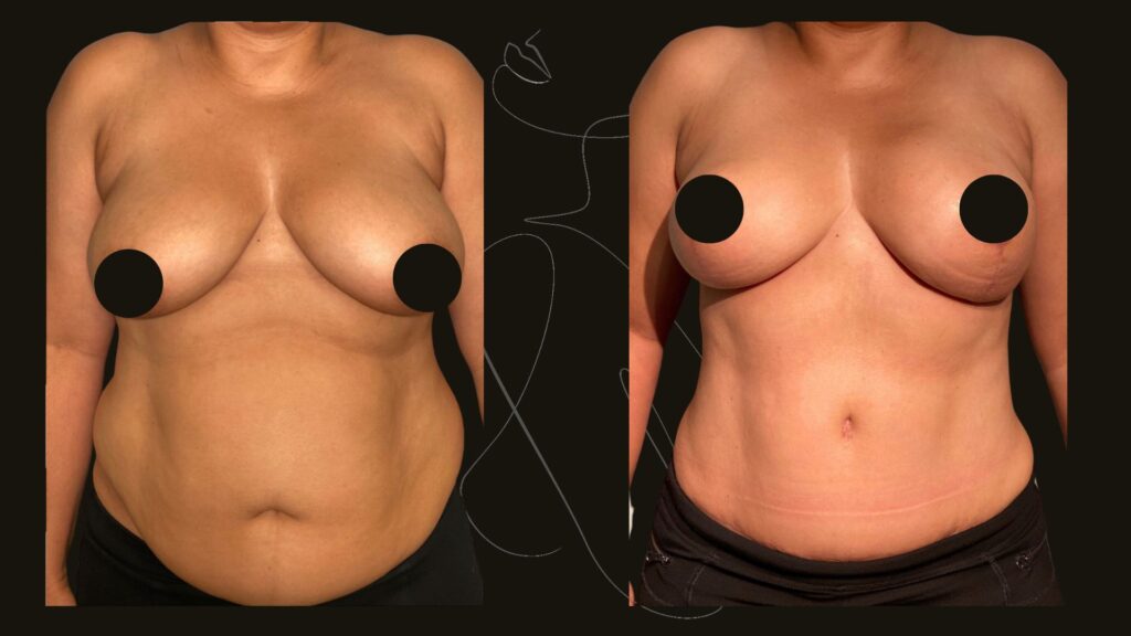 Breast Reduction