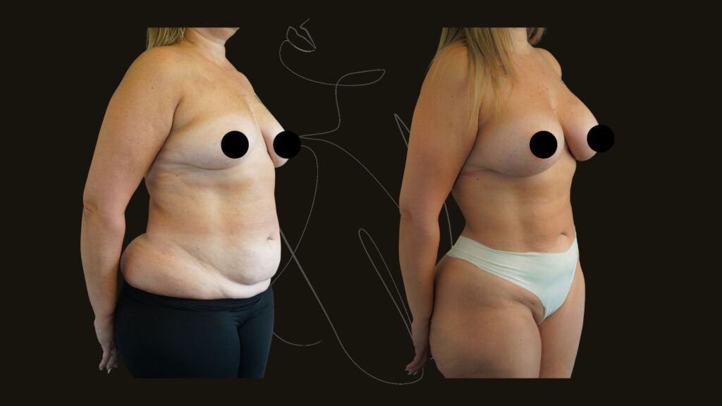 Mommy Makeover