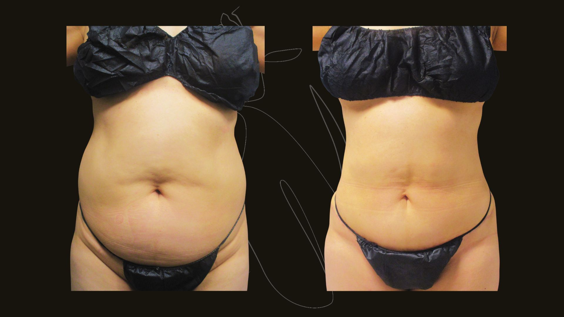 Liposuction