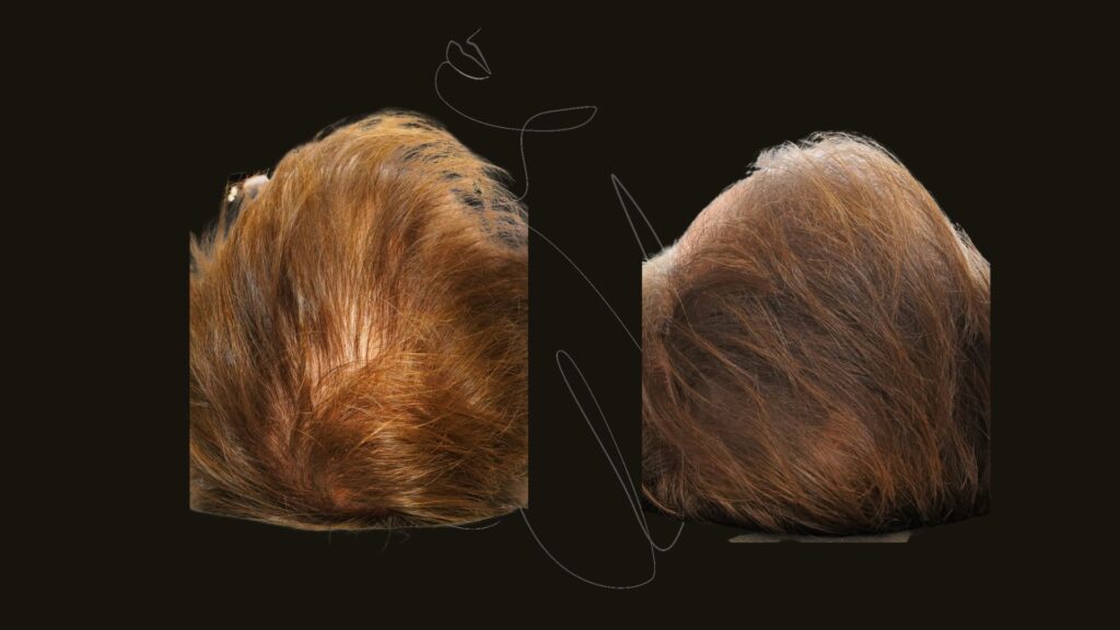 Hair Restoration