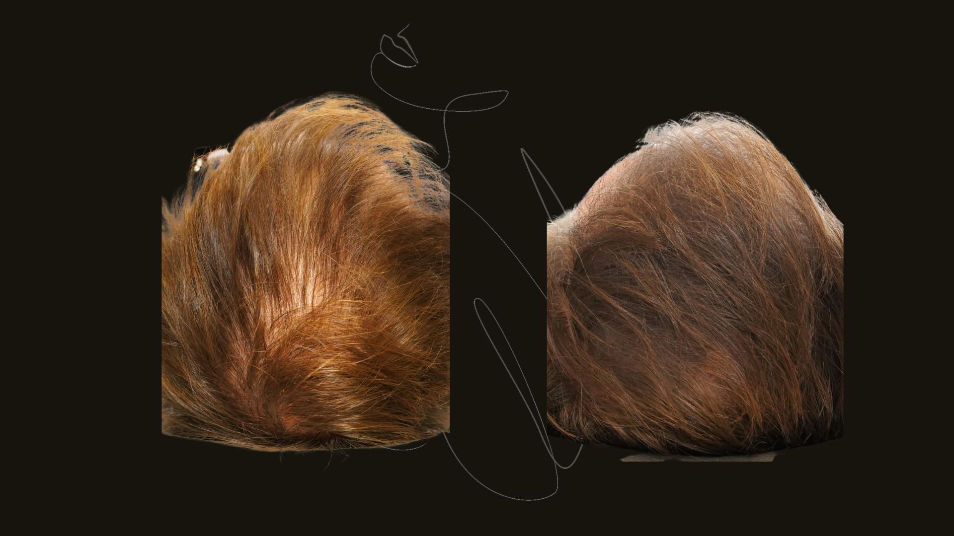 Hair Restoration