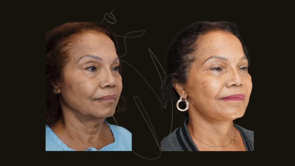 Face Lift