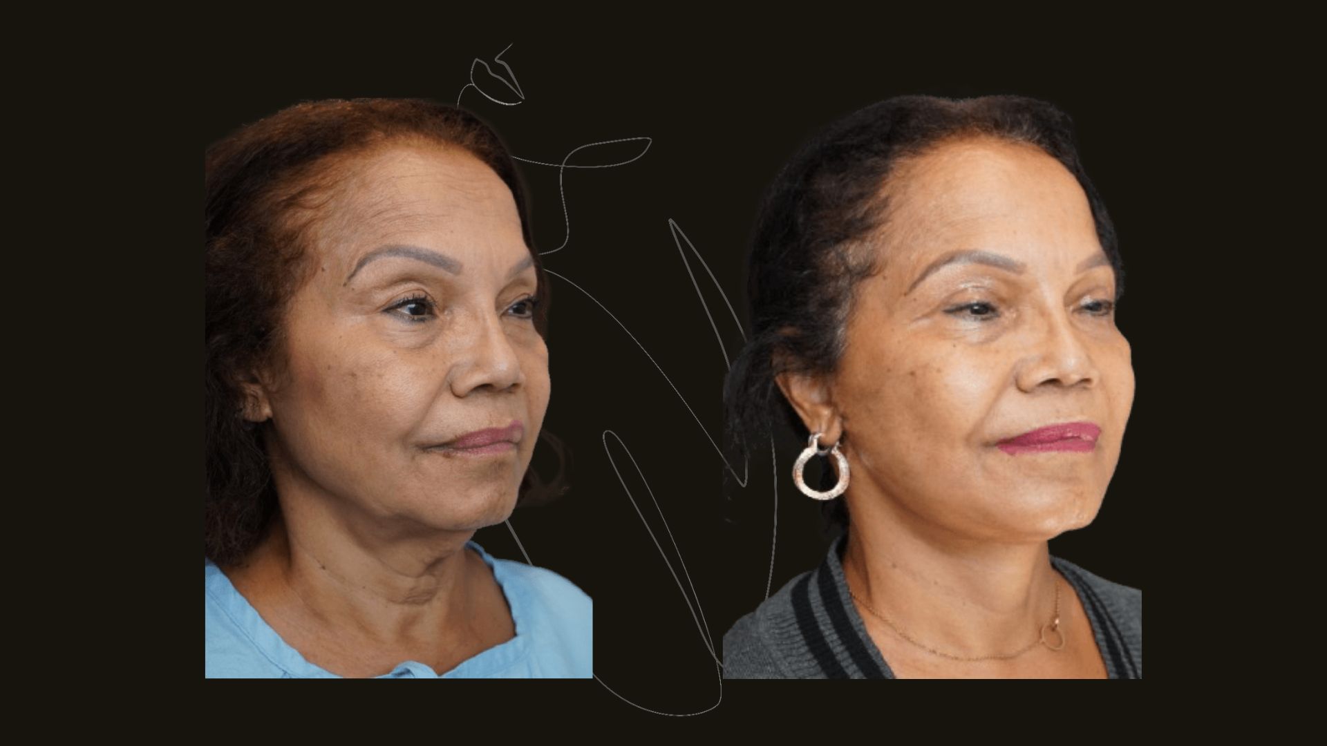 Face Lift