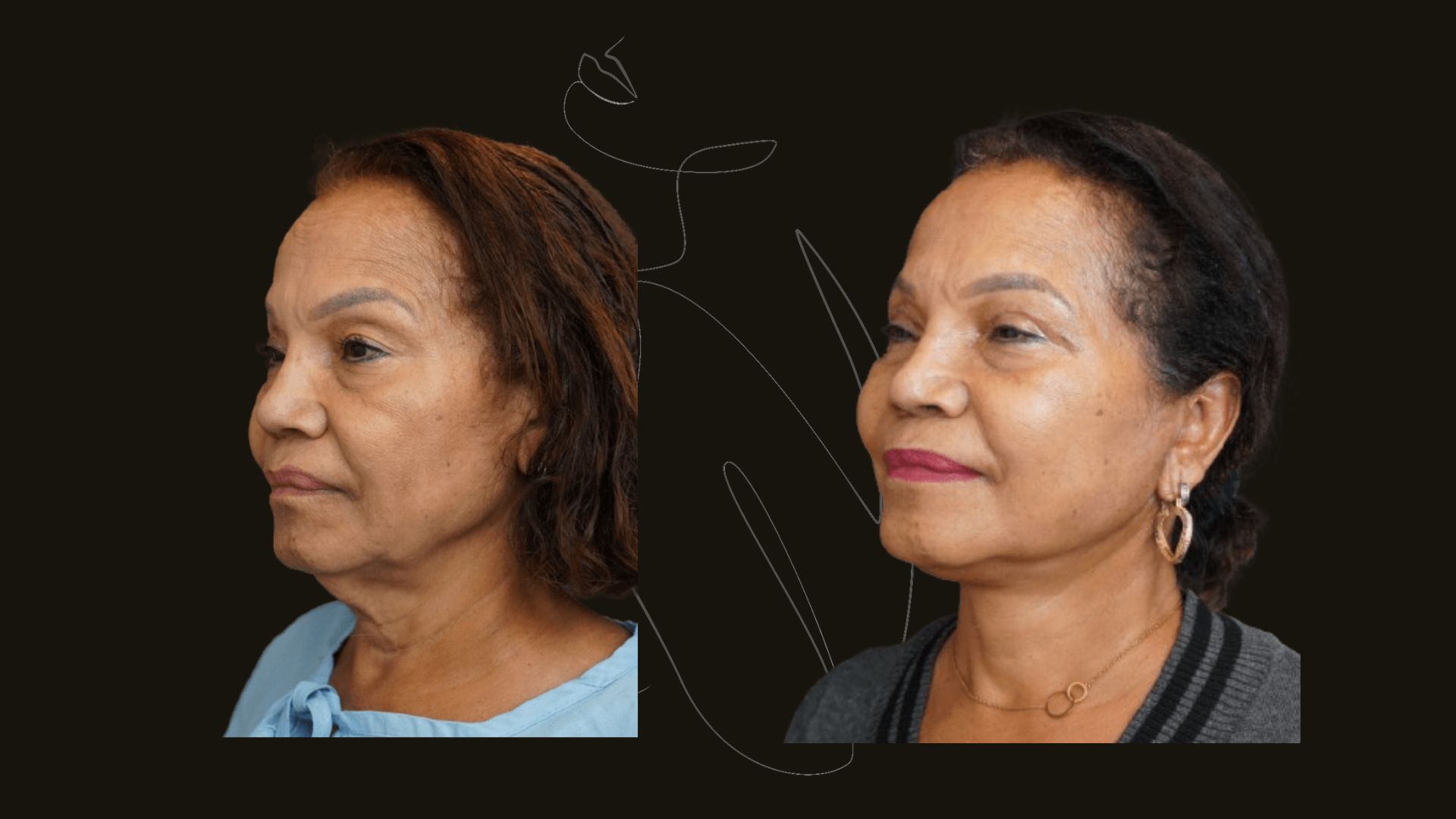 Face Lift
