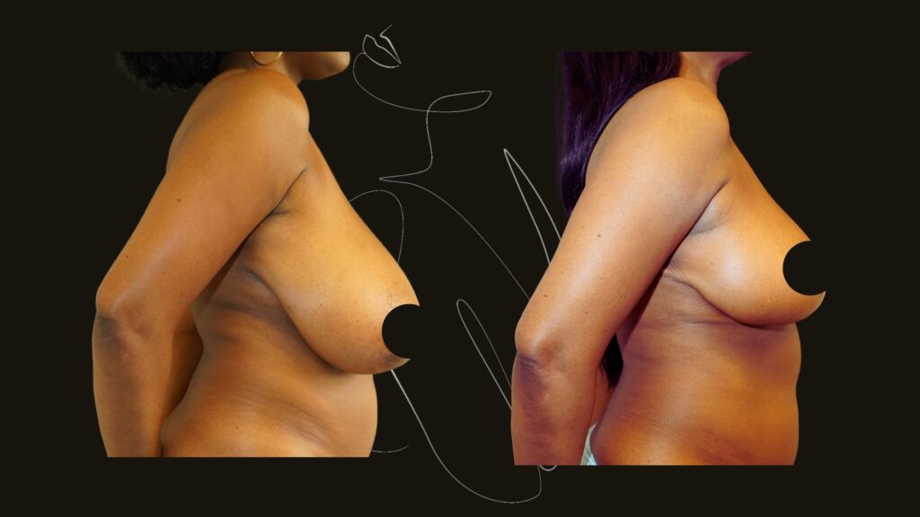 Breast Reduction