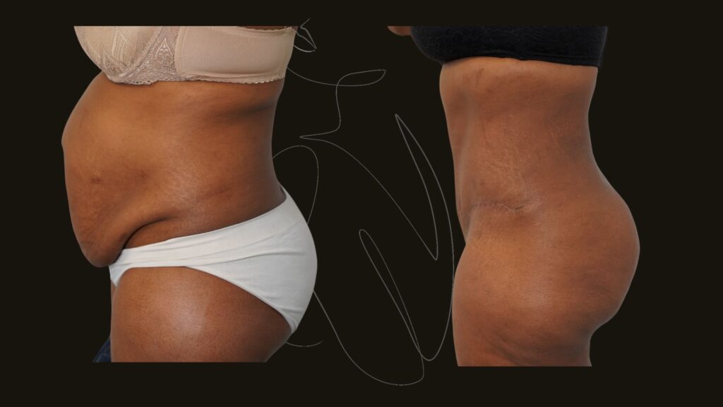 Tummy Tuck