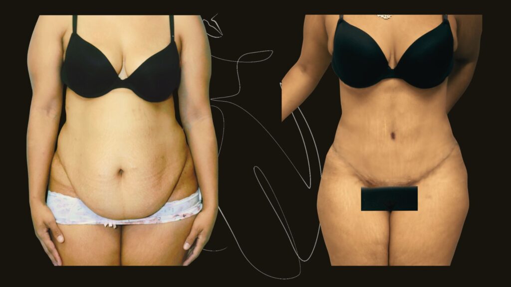Tummy Tuck