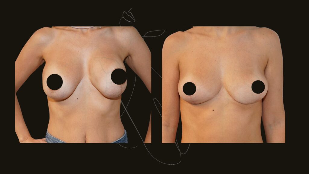 breast asymmetry