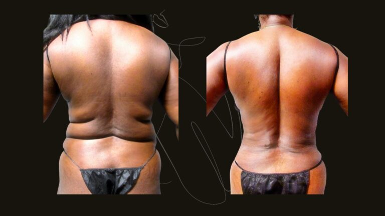 Liposuction