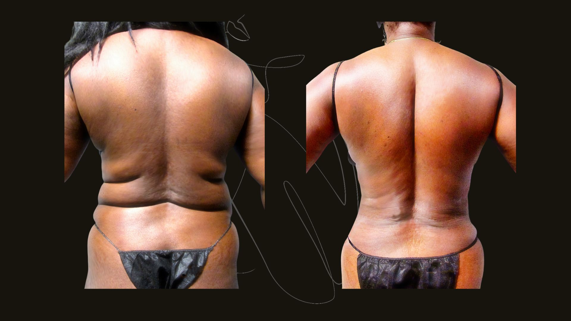 Liposuction