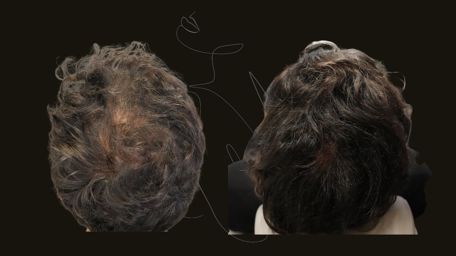 Hair Restoration