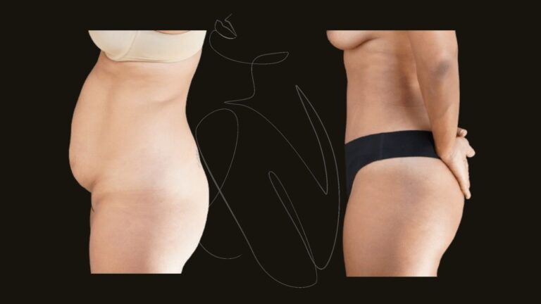 TummyTuck
