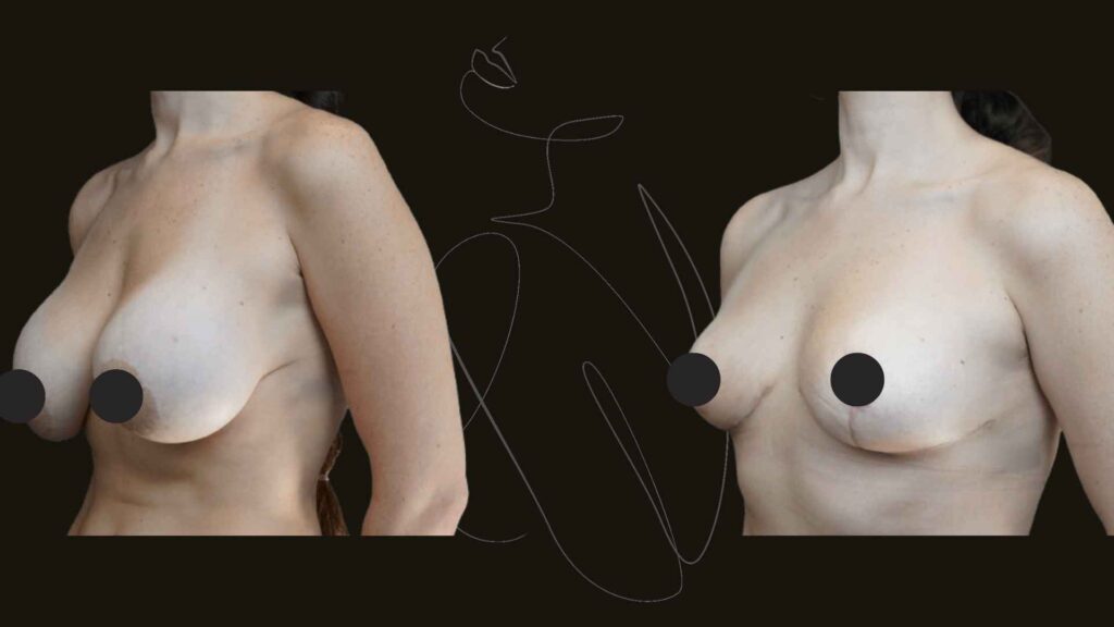 Breast Lift in NYC