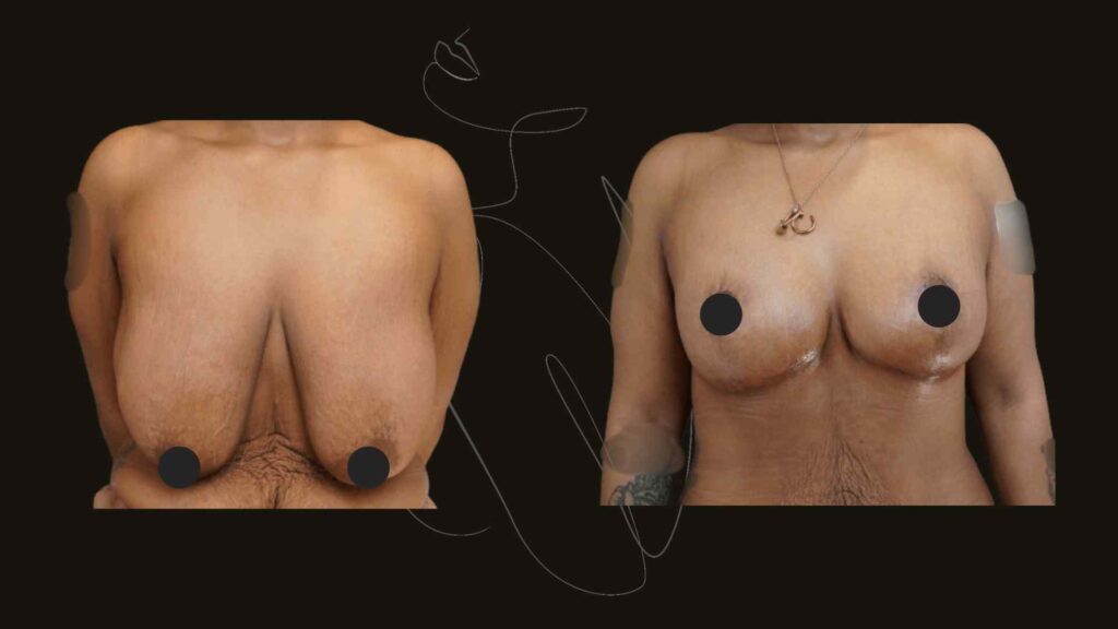 Breast Lift In NYC