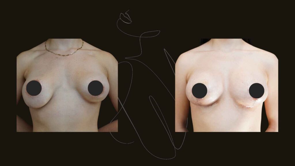 Breast Asymmetry in NYC
