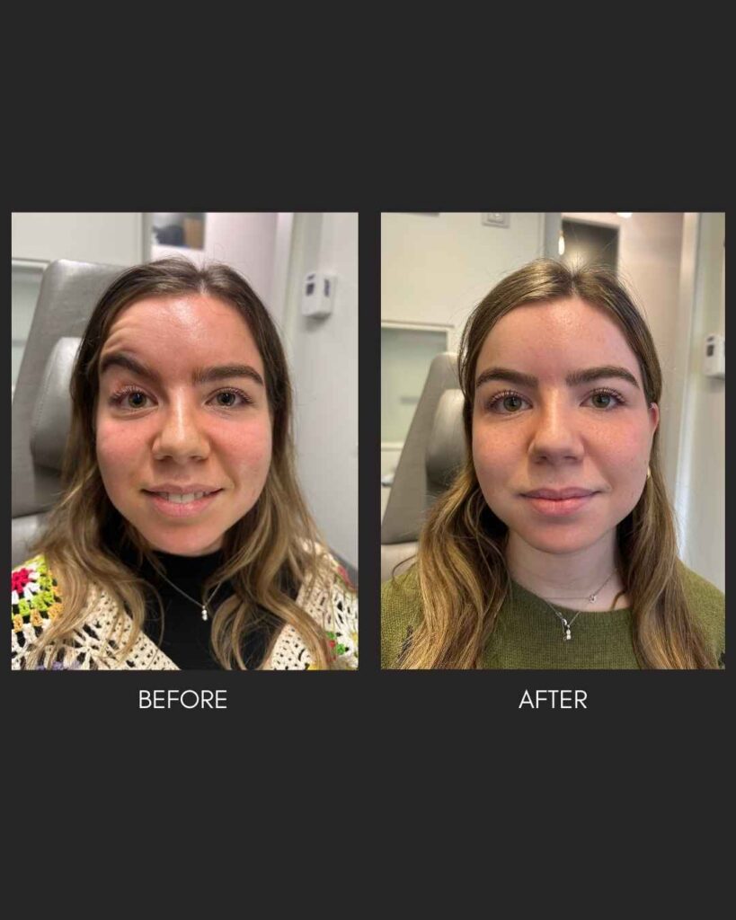 Botox NYC