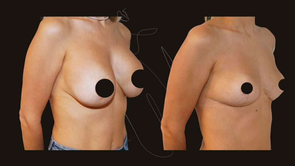 Breast Implants removal NYC