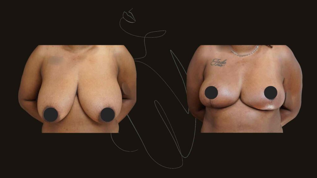 Breast Reduction
