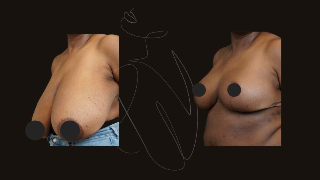 Breast Reduction and lift NYC