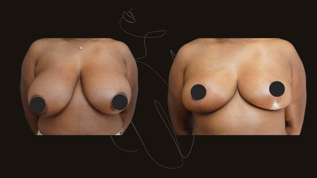 Breast Reduction and lift NYC