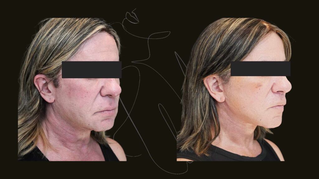 Facelift NYC