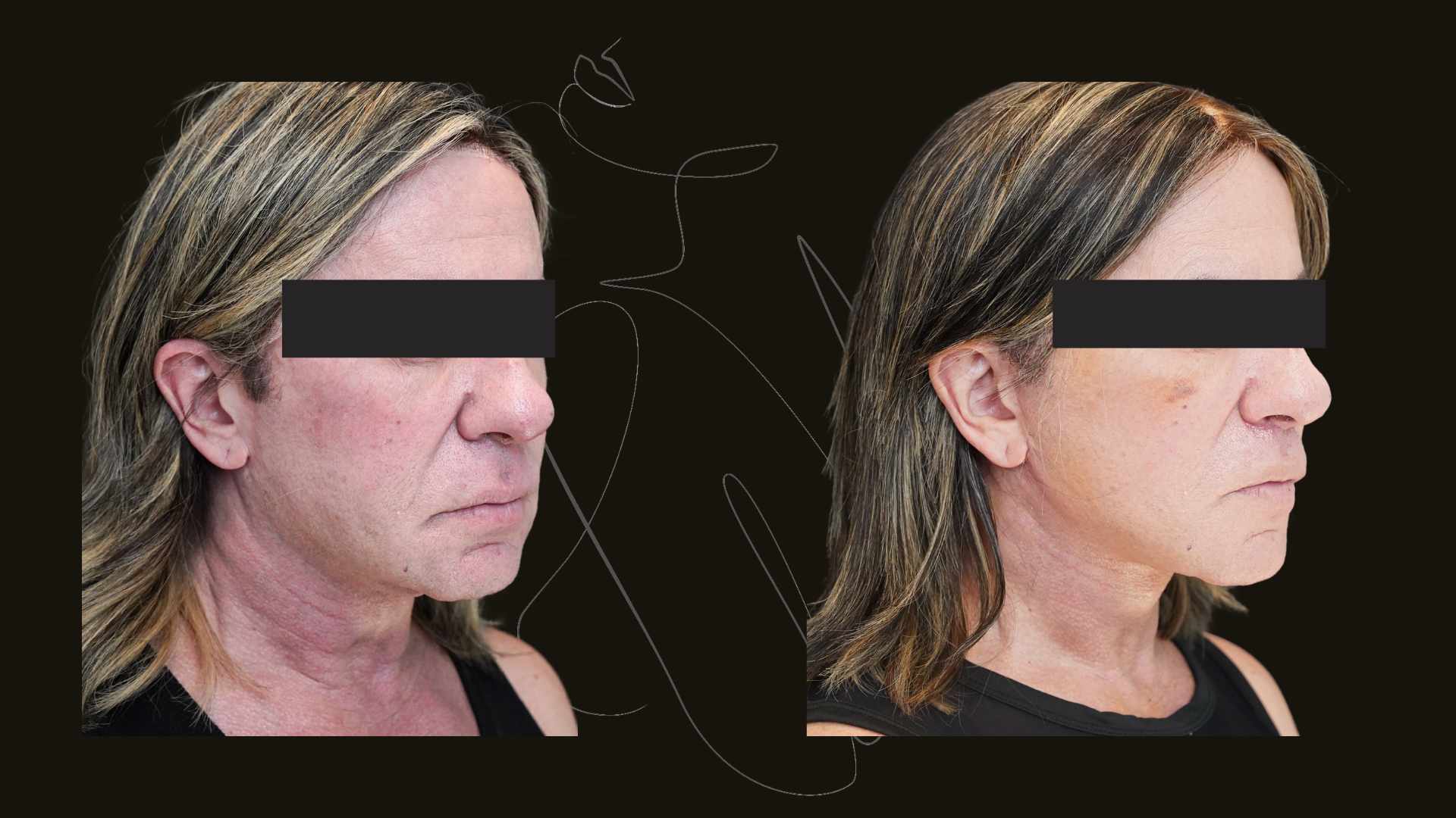 Facelift NYC