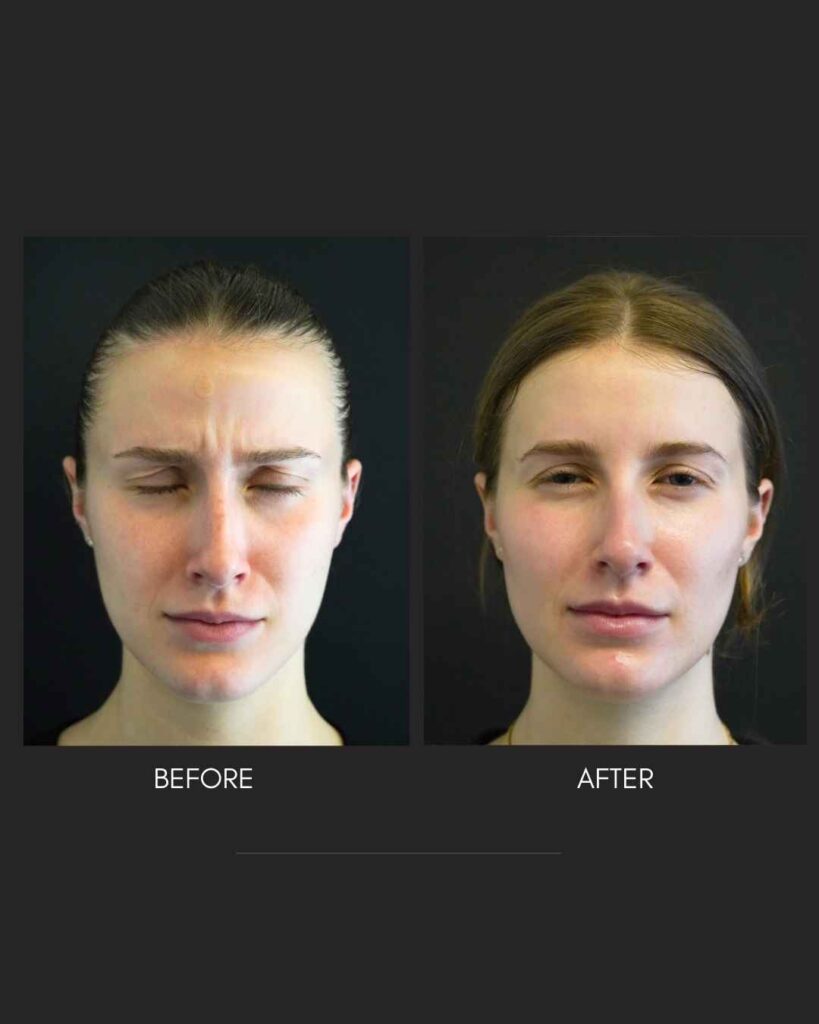 Botox NYC