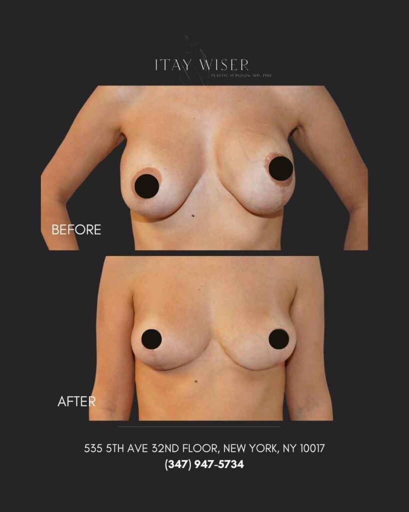 Removal Implants in NYC