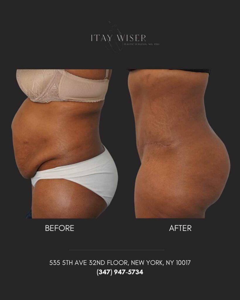 Tummy Tuck in NYC