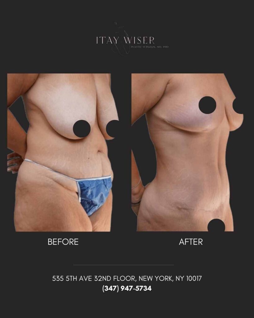 Tummy Tuck In NYC