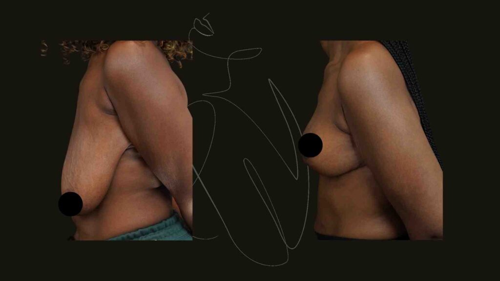 Breast Reduction and Breast lift NYC