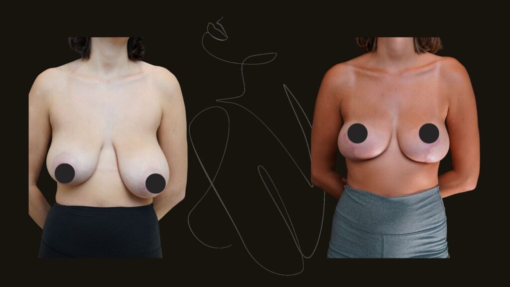 breast Assymetry