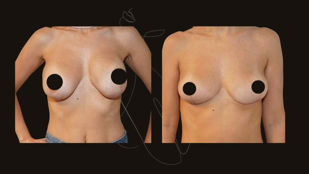 breast implants removal in NYC