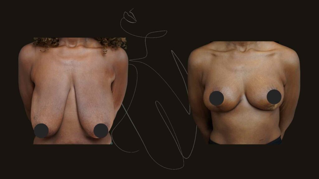 Breast Reduction and lift NYC