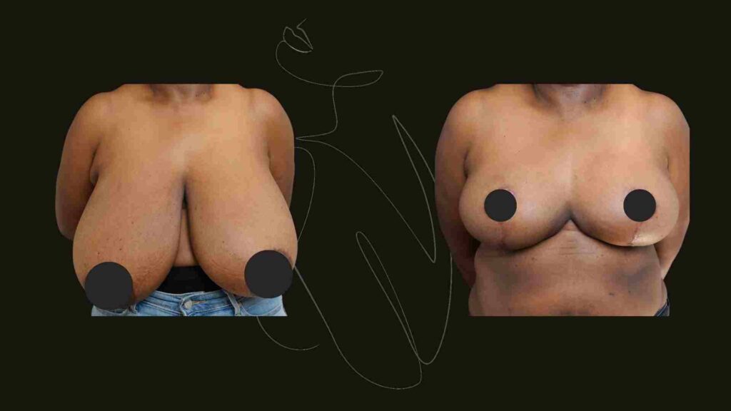 Breast Reduction and lift NYC