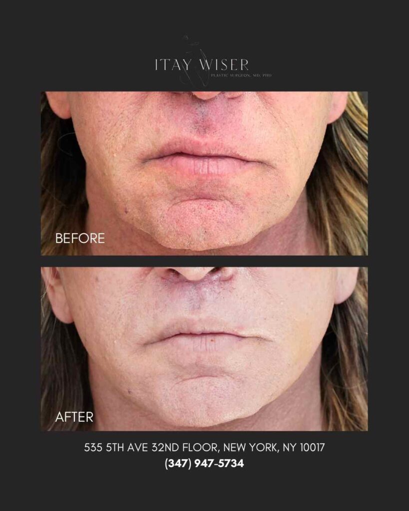 Lip Lift NYC