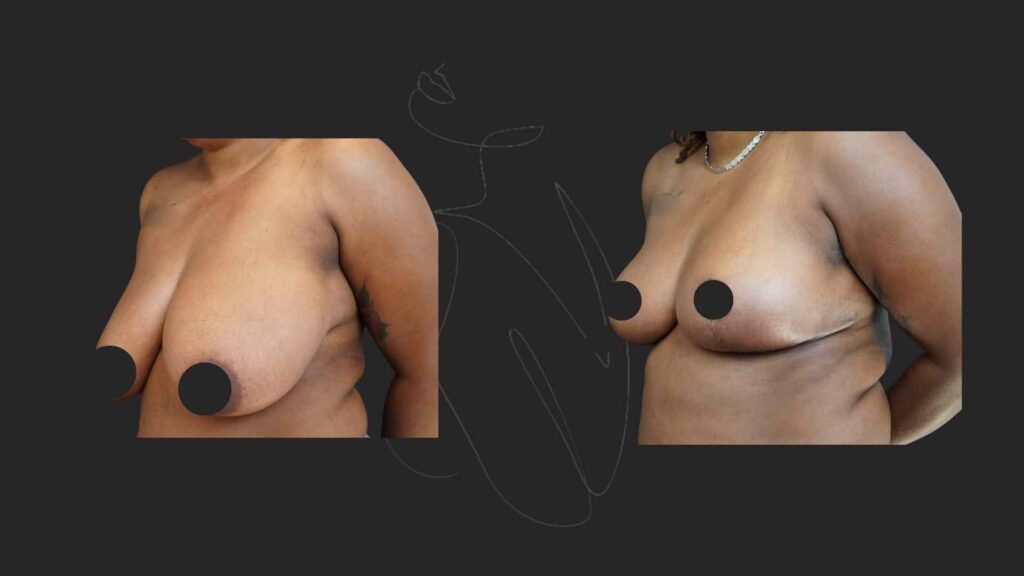 Breast Reduction & Breast Lift