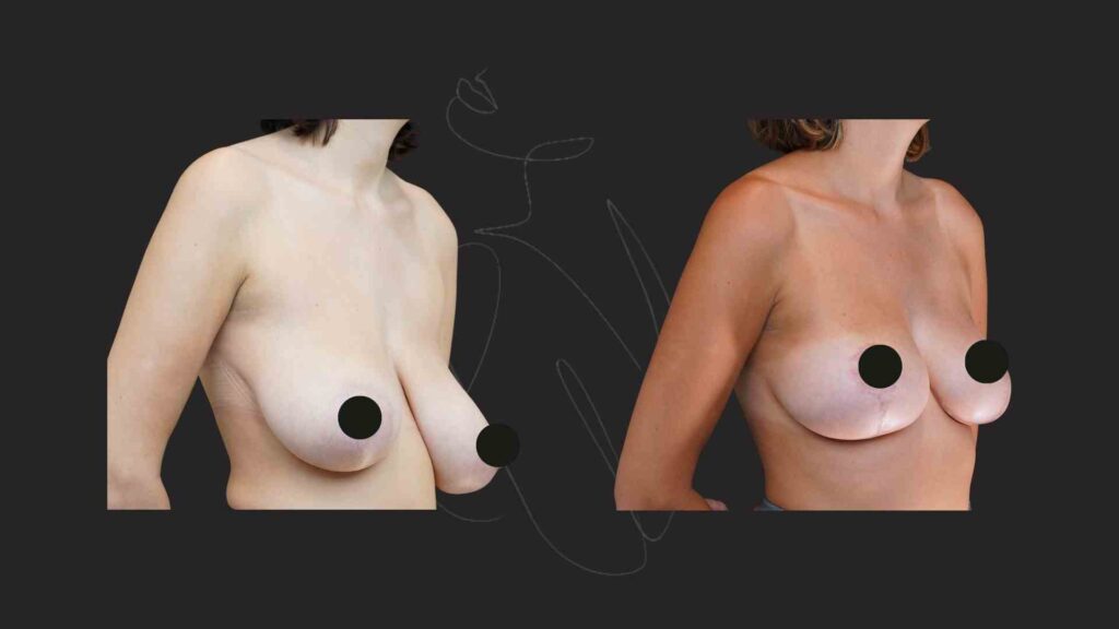 Breast Assymetry