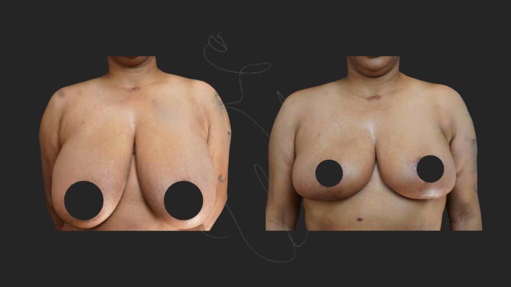 Breast Reduction & Breast Lift