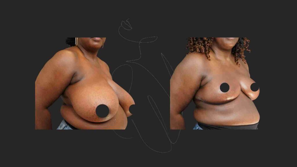 Breast Reduction& Breast Lift